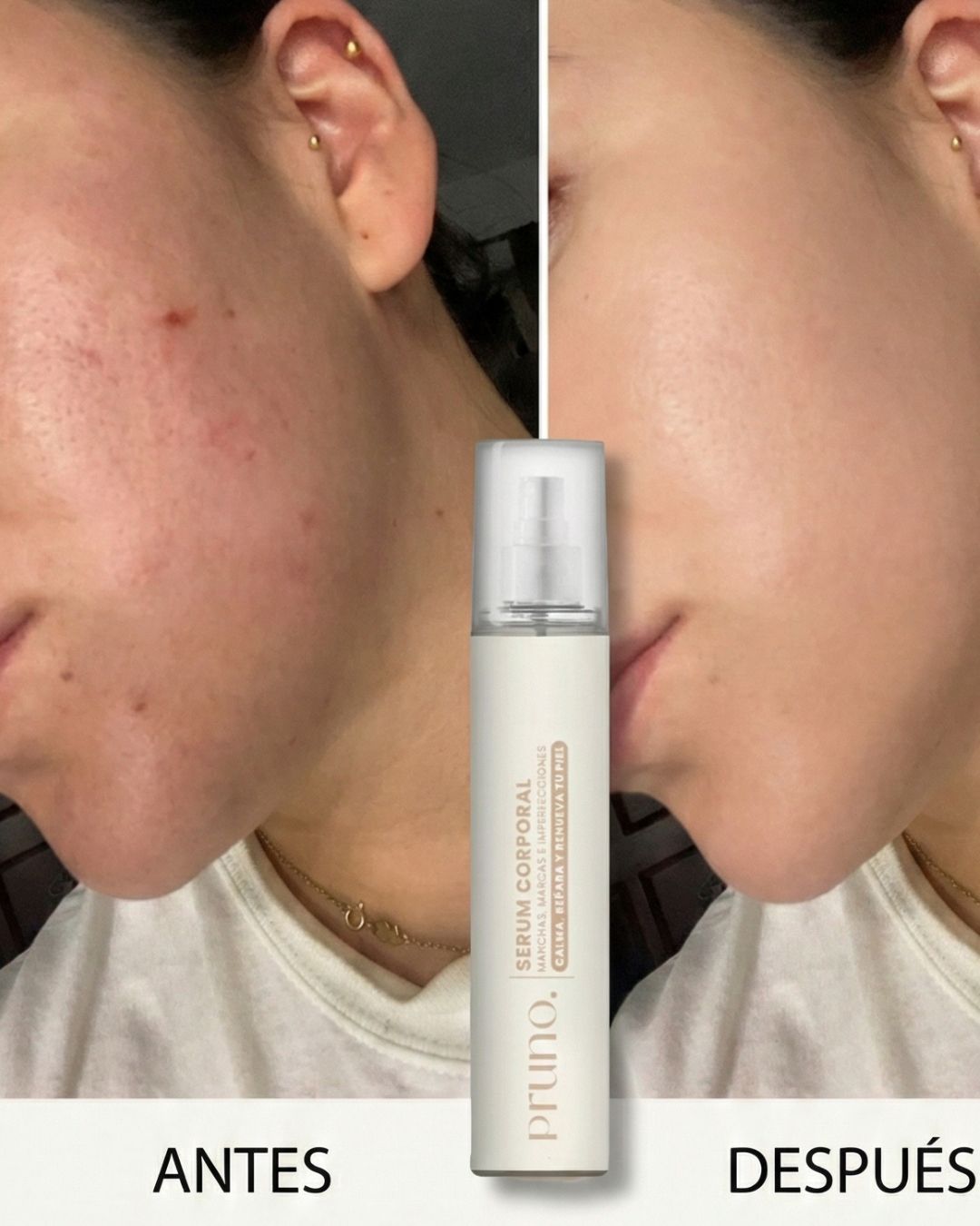 Sérum Corporal Auxiliar para Piel con Tendencia al Acné · 50 ml