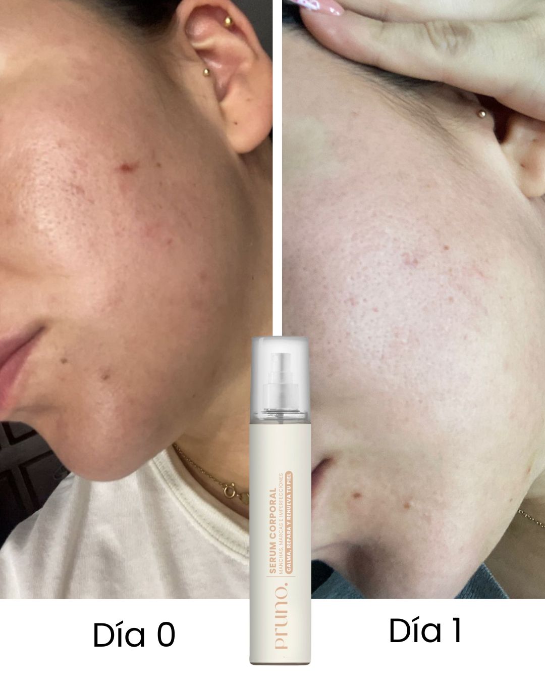 Sérum Corporal Auxiliar para Piel con Tendencia al Acné · 50 ml